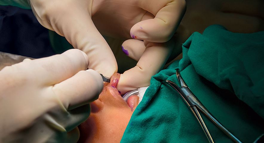 cleft surg