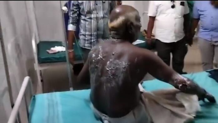 ದಲಿತ ವ್ಯಕ್ತಿಗೆ ಬೆಂಕಿ ಹಚ್ಚಿದ ಸವರ್ಣೀಯರು