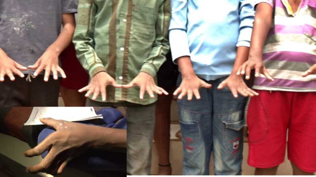 ಫಂಗಸ್‌ ಸೋಂಕು